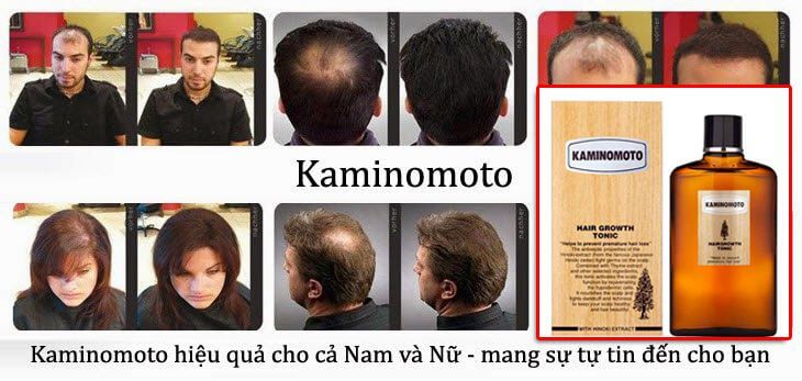 Thuốc mọc tóc cho nam Lưu ý khi dùng phân loại và cách chọn lựa  Qik Hair